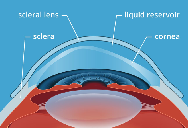 Scleral